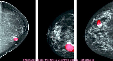 Researchers are working to replace gold standard of breast tissue scanning with a Photoacoustic Methodology